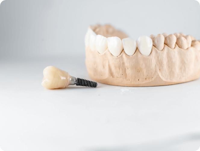 ジルコニアクラウン